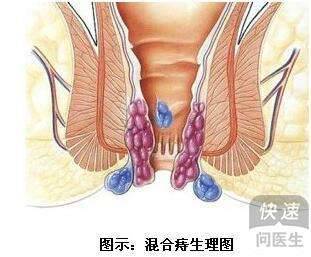 孕产妇要注意 合并重度混合痔盯上了你